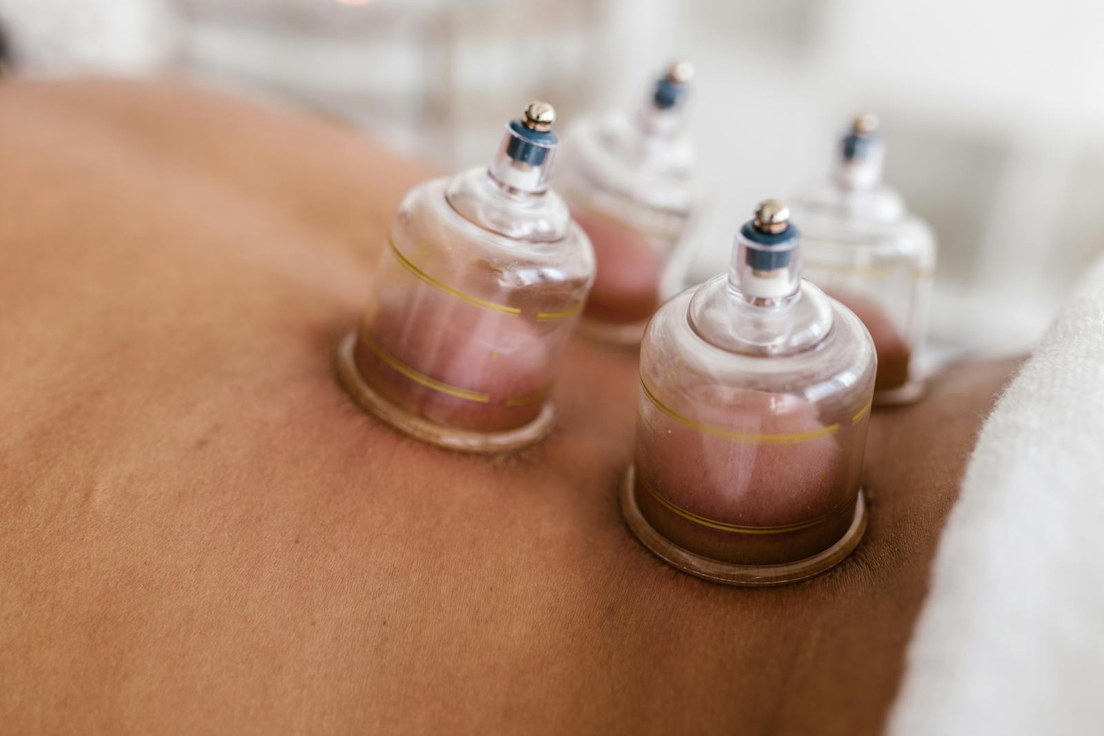 Detailed image of cupping therapy on a person's back, showcasing alternative medicine practice.